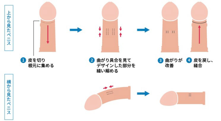 施術の流れのイラスト