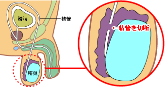 精管切断の図解