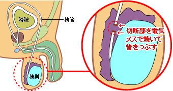 切断部を電気メスで焼く方法の図解