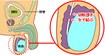 切断部を糸で結ぶ方法の図解