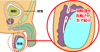 切断部を反転させて糸で結ぶ方法の図解