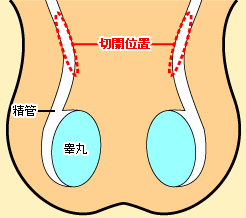 当院の複合根治術の図解