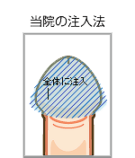 当院の注入法イラスト